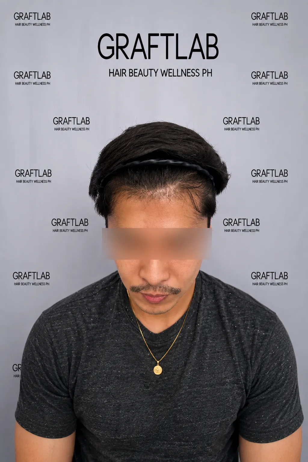 Hairline restoration, 2,400 grafts, 12 months — after