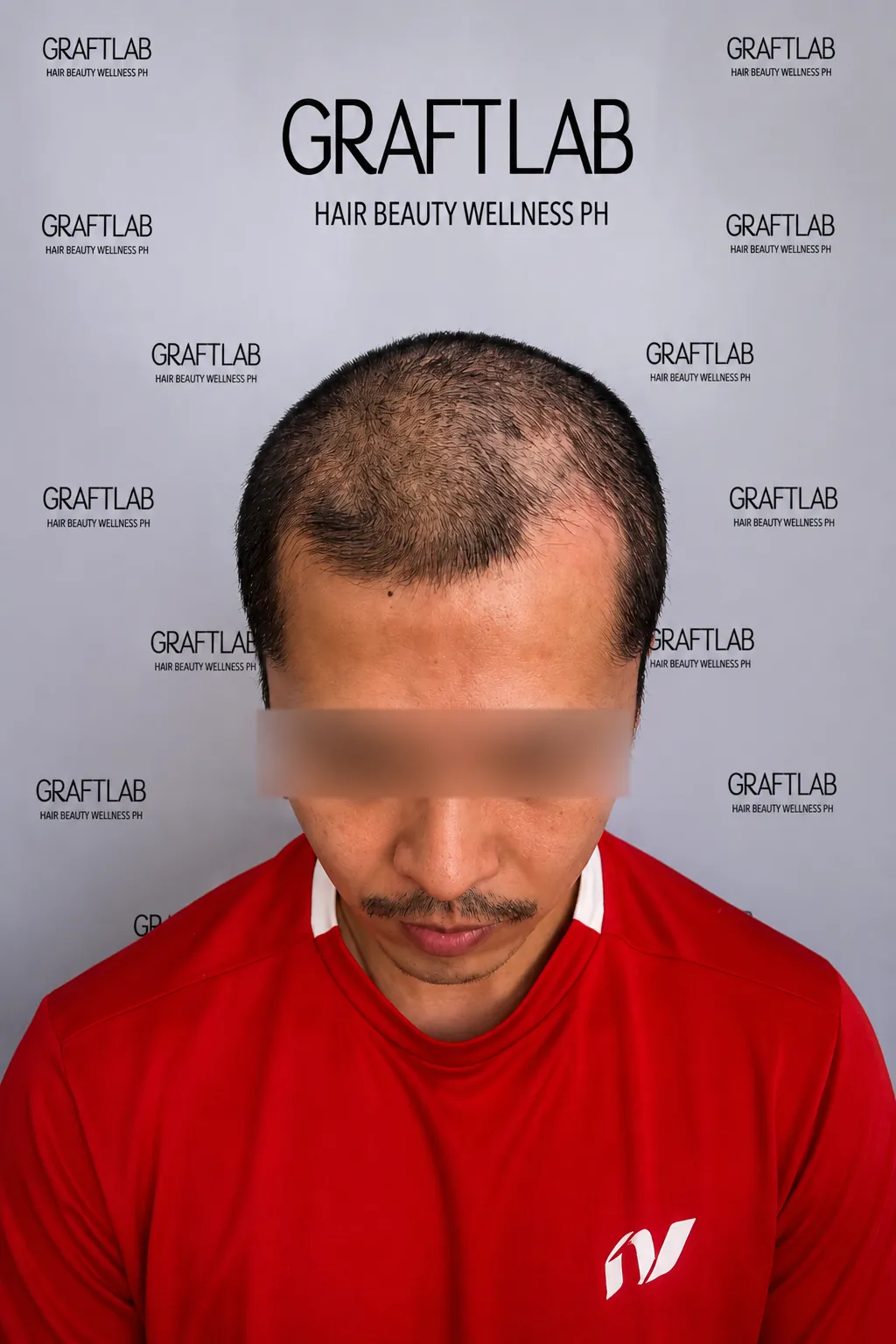 Hairline restoration, 2,400 grafts, 12 months — before