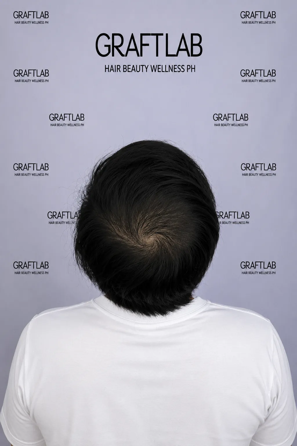 Crown restoration, 2,800 grafts, 6 months — after
