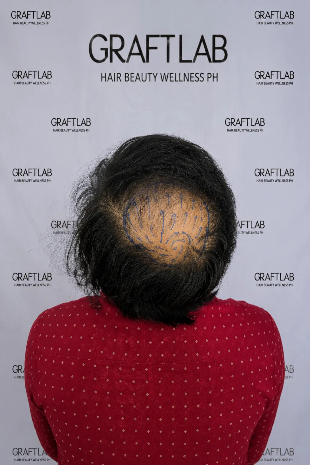 Crown restoration, 2,800 grafts, 6 months — before