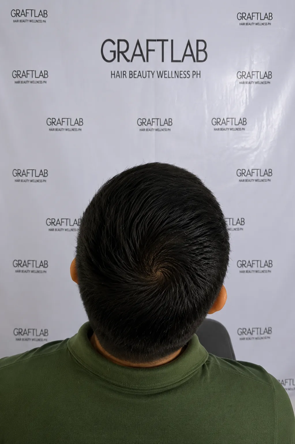 BA-003 after — Full head restoration · 4,500 grafts · 12 months · M.S., 45