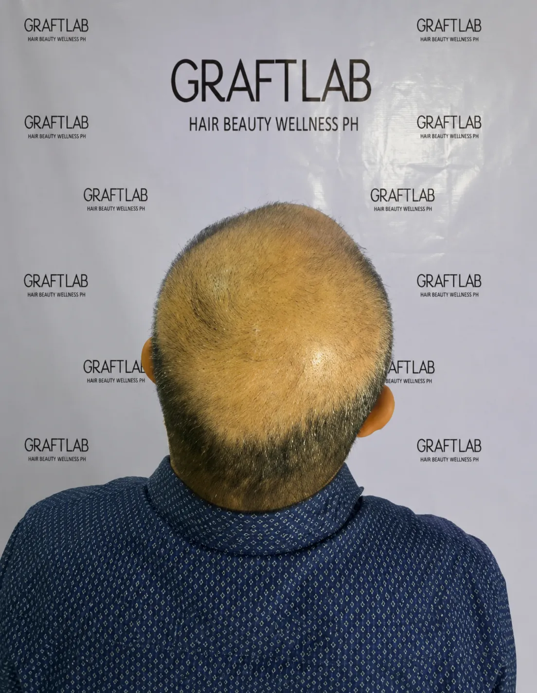 BA-003 before — Full head restoration · 4,500 grafts · 12 months · M.S., 45
