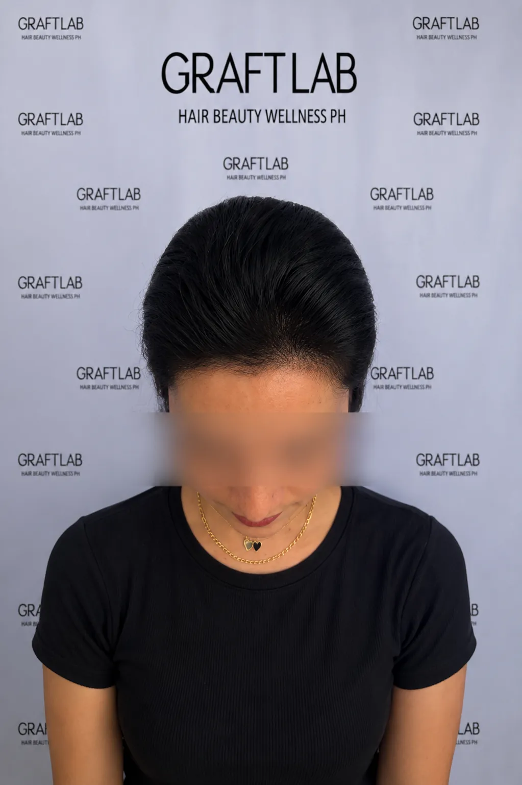 Hairline lowering, 1,800 grafts, 12 months — after