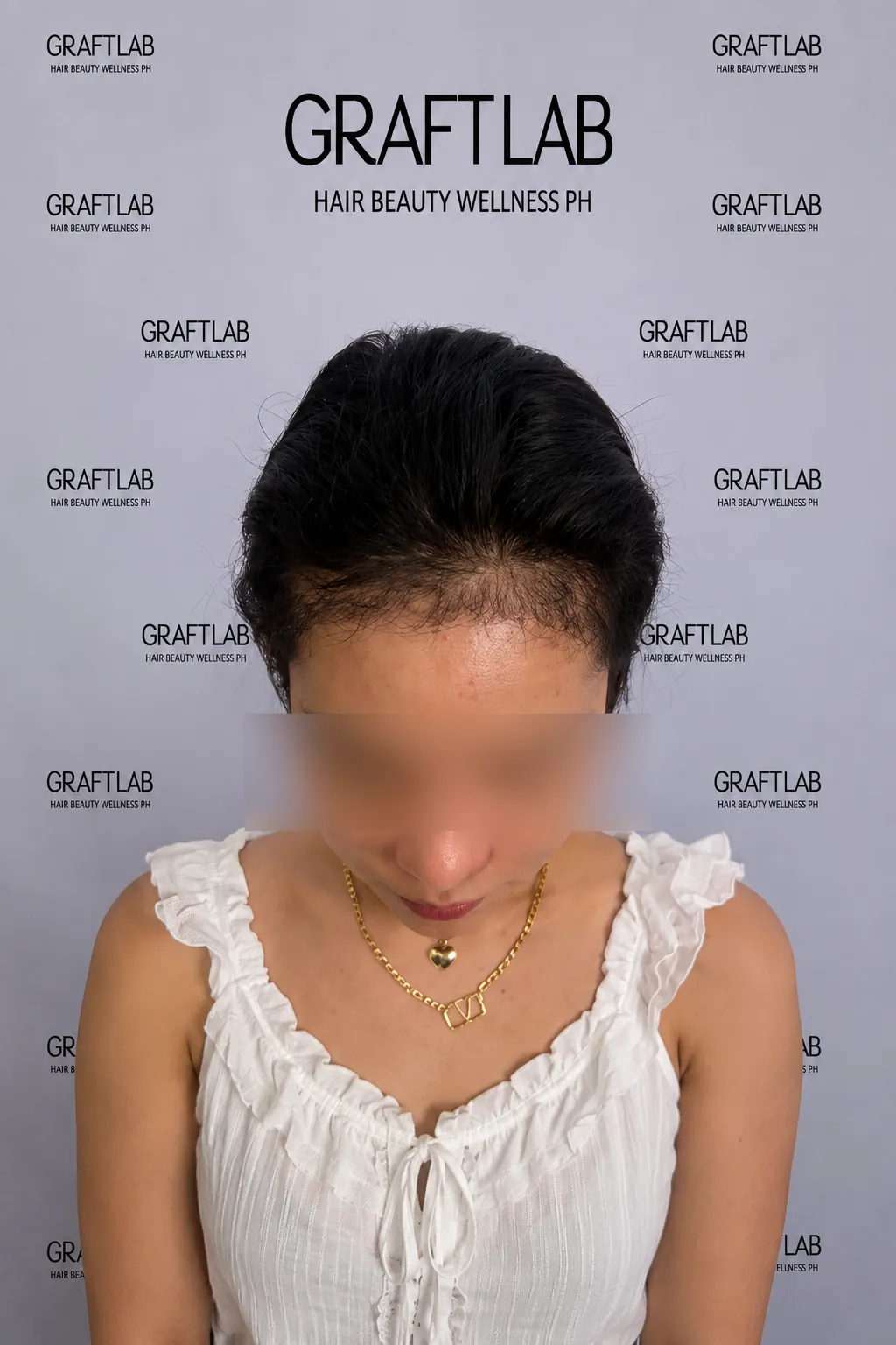 Hairline lowering, 1,800 grafts, 12 months — before