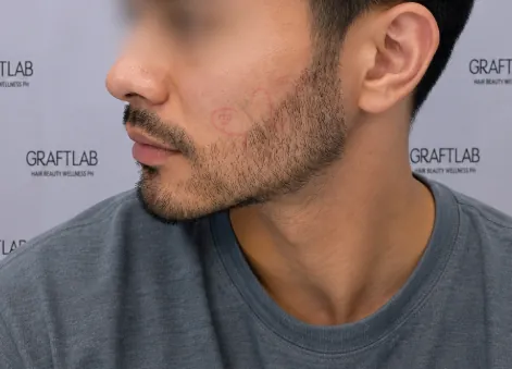Beard and moustache transplant, 1,200 grafts, 6 months — after