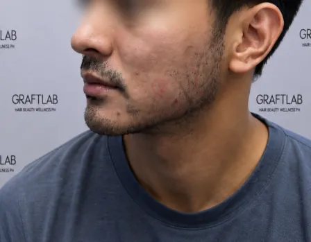 Beard and moustache transplant, 1,200 grafts, 6 months — before