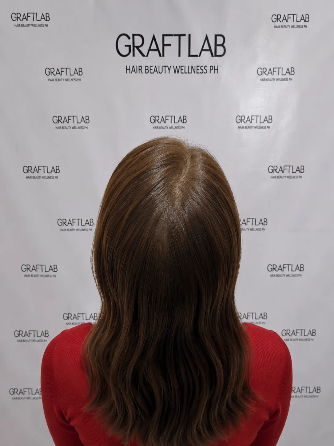 Diffuse thinning restoration, 2,000 grafts, 12 months — after