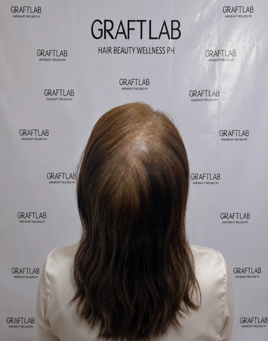 Diffuse thinning restoration, 2,000 grafts, 12 months — before
