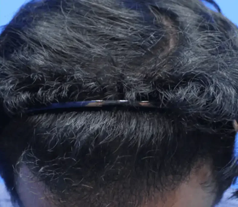 BA-007 after — Hairline restoration · treated by Dr. Inder's team, Malaysia