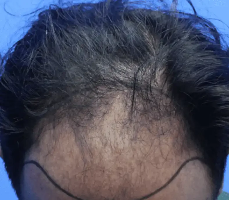 BA-007 before — Hairline restoration · treated by Dr. Inder's team, Malaysia