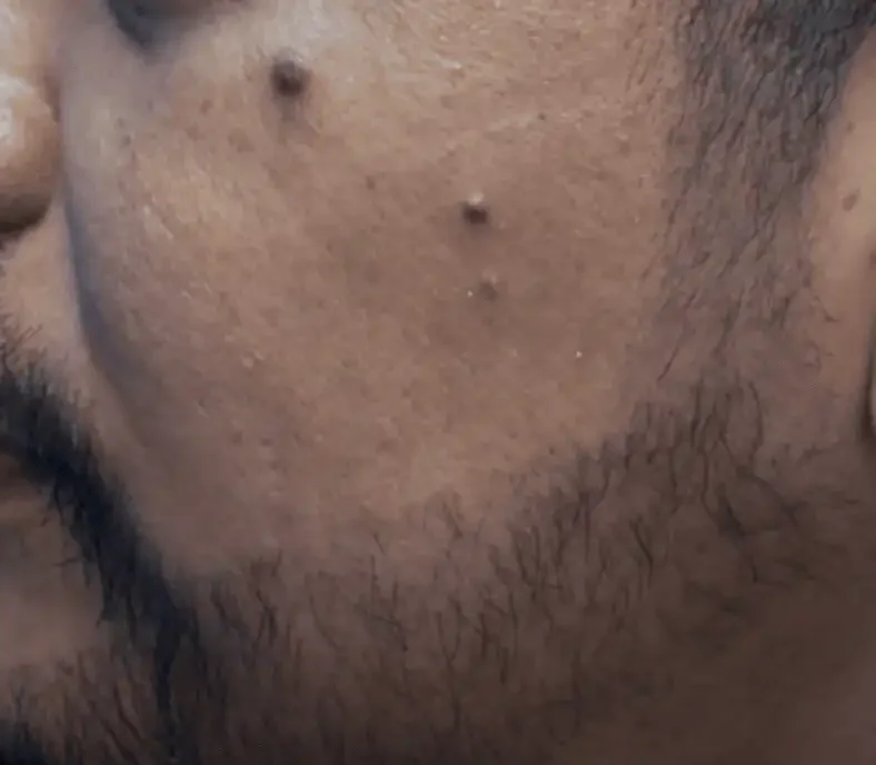 BA-008 after — Beard restoration · treated by Dr. Inder's team, Malaysia