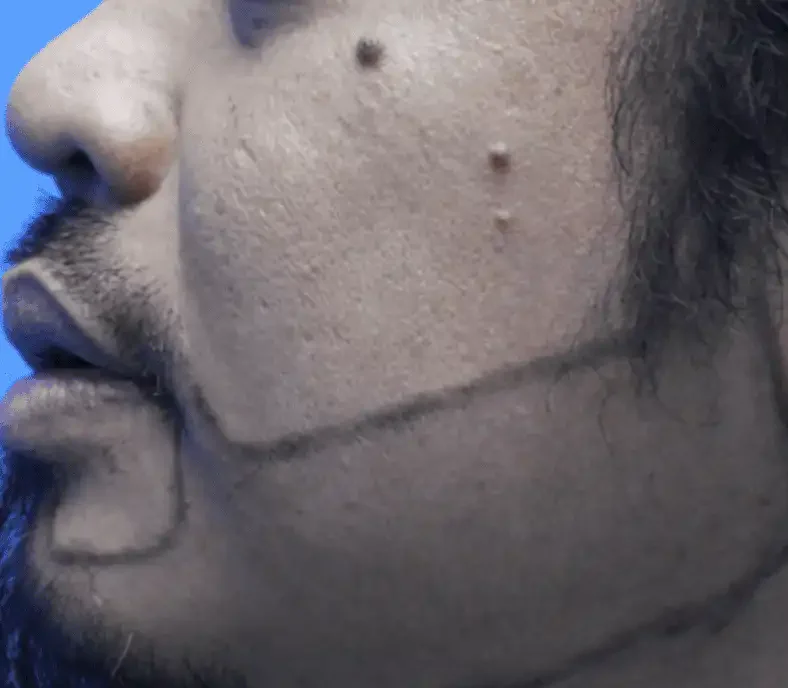 BA-008 before — Beard restoration · treated by Dr. Inder's team, Malaysia