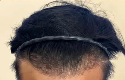 BA-009 after — Hairline restoration · 3,000 grafts · 1 year · GraftLab Manila