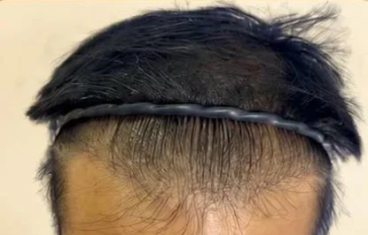 BA-009 before — Hairline restoration · 3,000 grafts · 1 year · GraftLab Manila