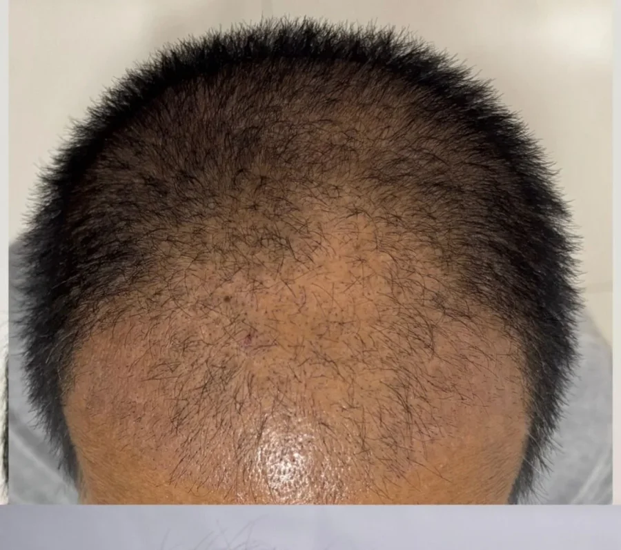 BA-011 before — Crown restoration · GraftLab Manila