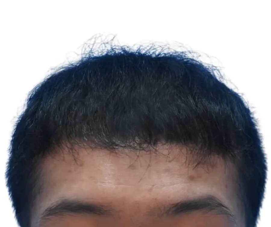 BA-013 after — Hairline restoration · GraftLab Manila