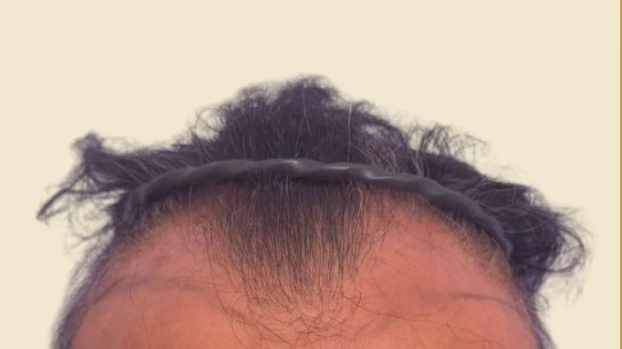 BA-015 before — Hairline restoration · 2 months · GraftLab Manila