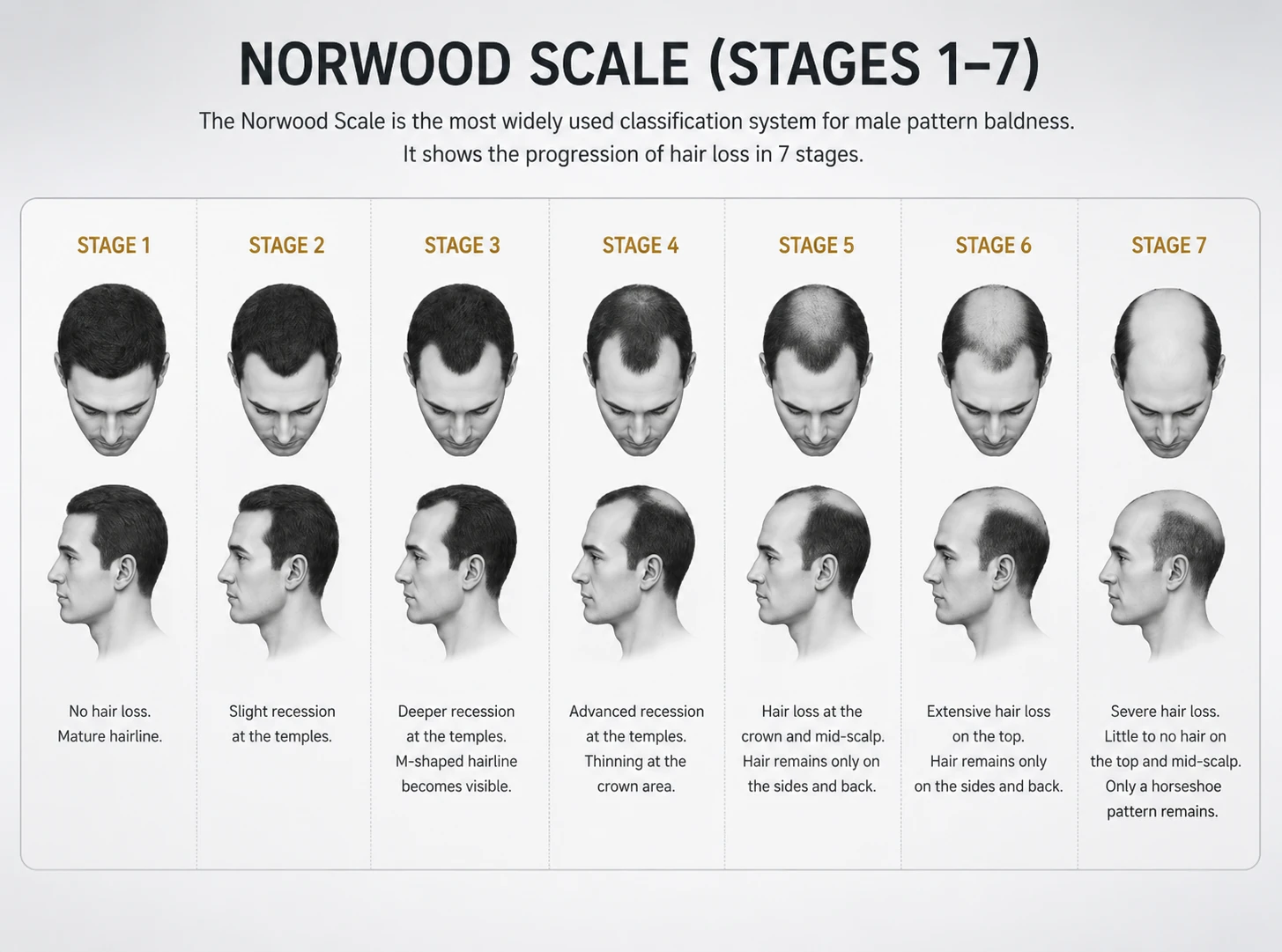 Norwood scale diagram showing the seven stages of male pattern hair loss progression, with front and side views from Stage 1 (mature hairline) through Stage 7 (horseshoe pattern).