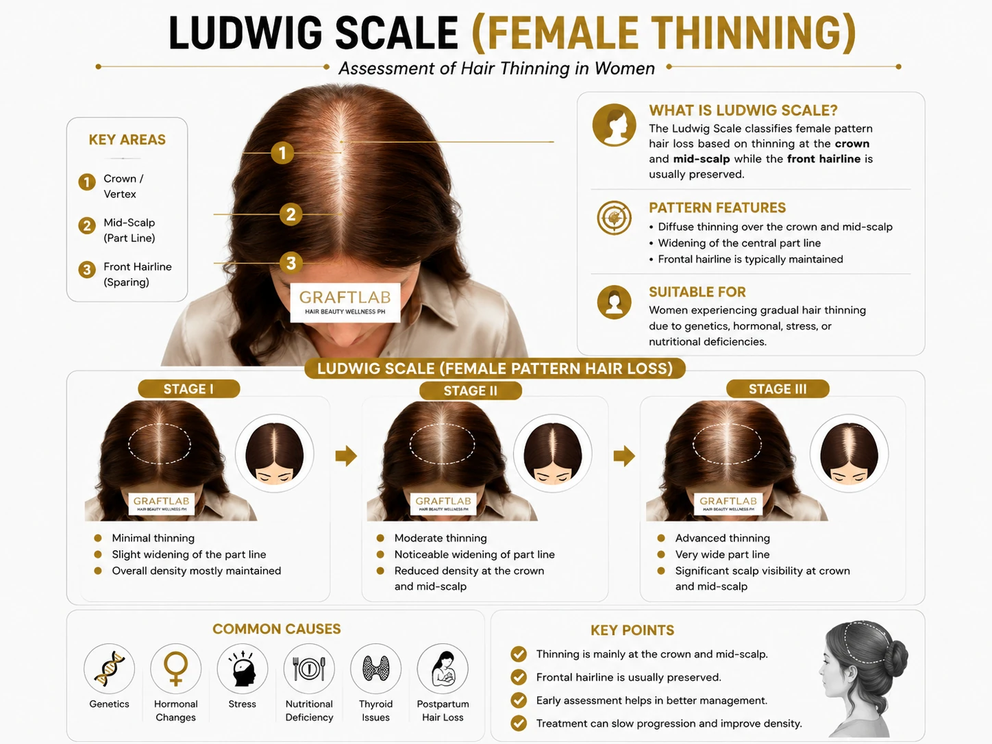 Ludwig Scale infographic — female pattern hair loss key areas (crown, mid-scalp, front hairline), stages I–III, common causes and key points.