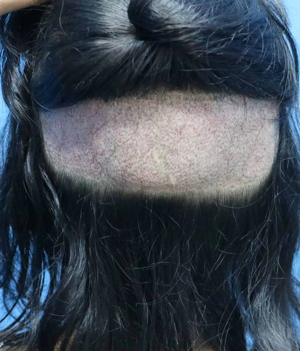 The narrow shaved donor strip under a woman's long hair after a long-hair FUE procedure.