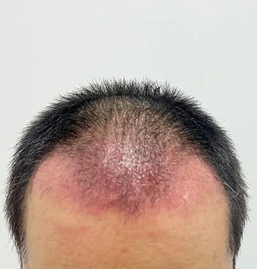 Hair transplant recovery, weeks 2–4: transplanted hairs shed — expected